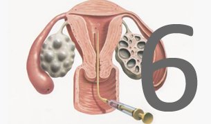 embryo-transfer